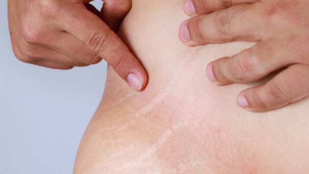 silver stretch marks on hip